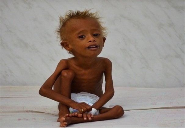 استفاده عربستان از سلاح گرسنگی دادن س از تحقیر شدن در یمن