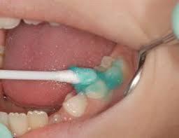 خدمات فلوراید تراپی ۷۴ هزار دانش آموز در پارسال