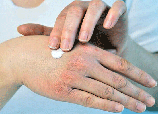 برای مقابله با خشکی پوست در زمستان چه کنیم؟ برای مقابله با خشکی پوست در زمستان چه کنیم؟