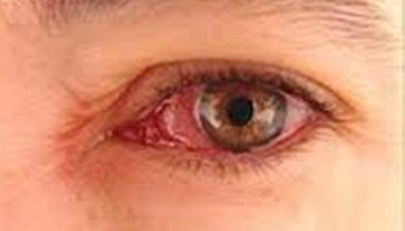 از بیماری تیروئید چشم چه می‌دانید؟