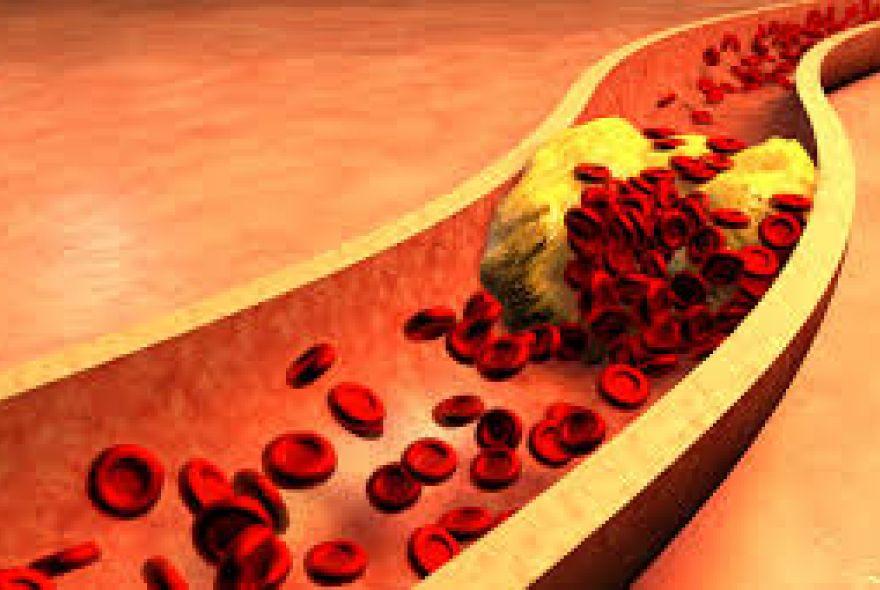 علائم کلسترول بالا در خون چیست؟