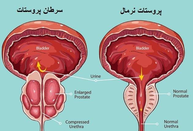 درمان نخستین سرطان پروستات مقاوم به درمان در غرب کشور