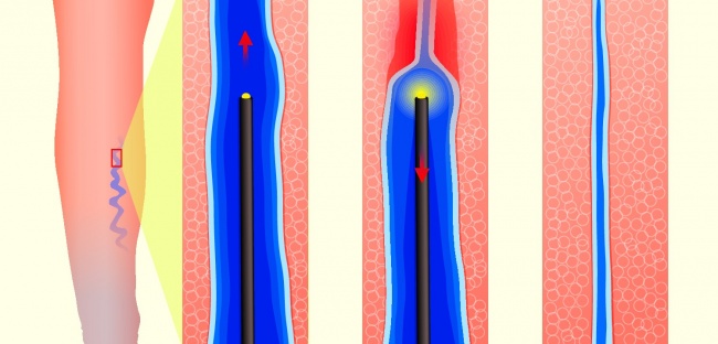 ۸ روش درمان واریس