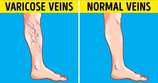 ۸ روش درمان واریس