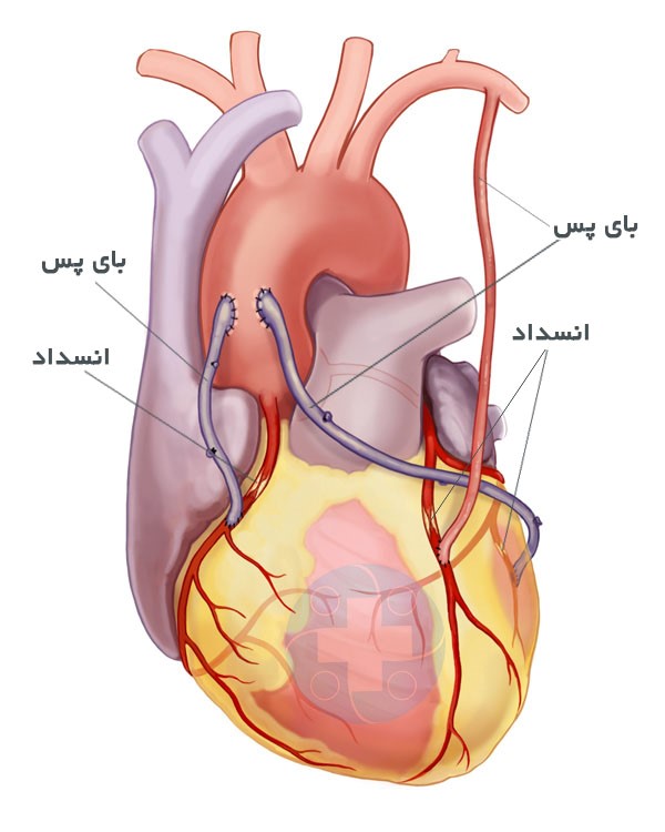 علائم گرفتگی رگ قلب