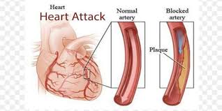 علائم گرفتگی رگ قلب
