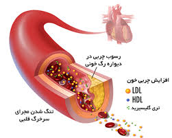 ضرورت کنترل فشارخون و چربی خون