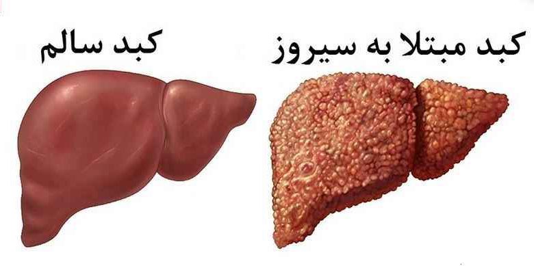 علل بیماری کبد علل بیماری کبد