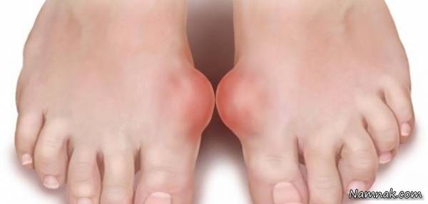 انحراف شست پا و درمان آن