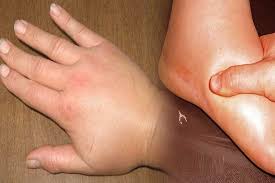 ۵ نشانه احتباس مایع در بدن ۵ نشانه احتباس مایع در بدن