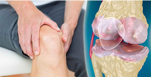 ورزشهای اختصاصی برای آرتروز ورزشهای اختصاصی برای آرتروز