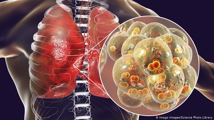 علائم درگیر شدن ریهها با کرونا چیست؟ علائم درگیر شدن ریهها با کرونا چیست؟