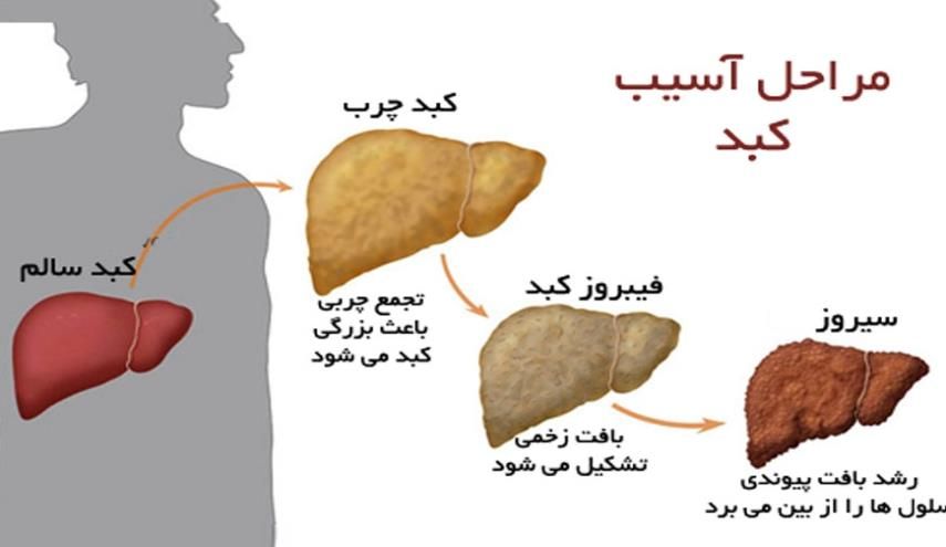 راه‌های پیشگیری و درمان بیماری کبد