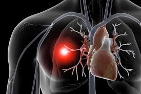 آیا ماسک موجب هایپرکاپنی می شود؟