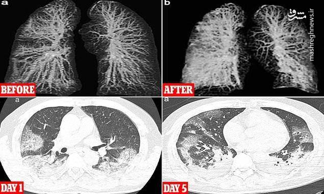 درگیری ریه در کرونا؛ از علائم تا درمان