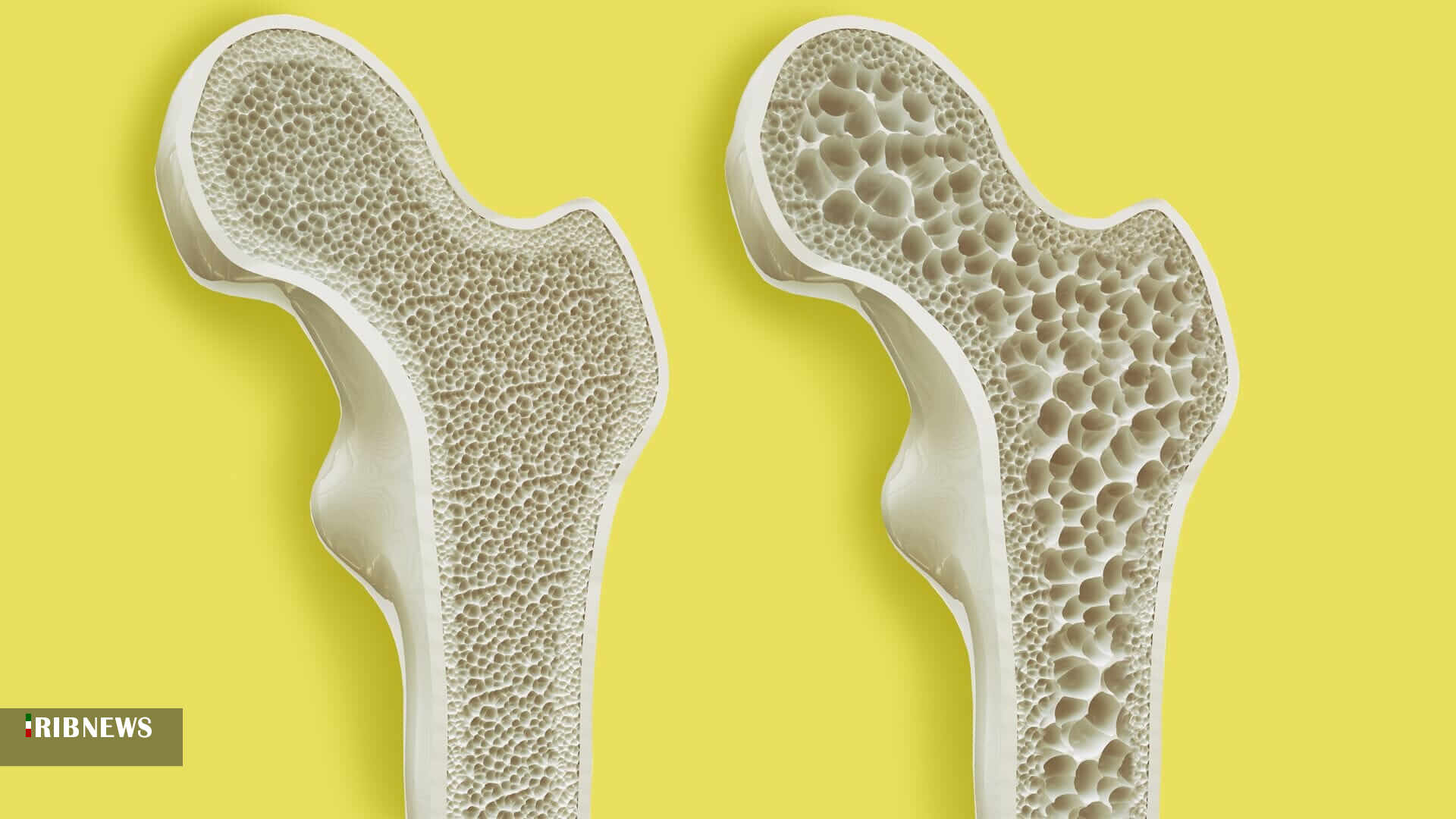 نقش تغذیه در پیشگیری از پوکی استخوان نقش تغذیه در پیشگیری از پوکی استخوان