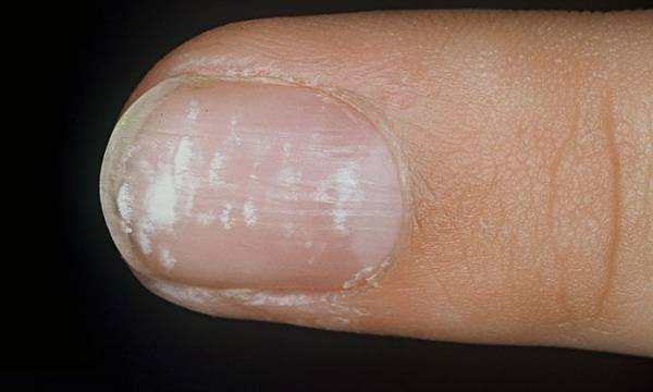 بررسی علل لکههای سفید روی ناخن کودکان بررسی علل لکههای سفید روی ناخن کودکان