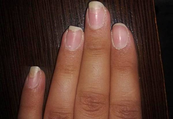 بررسی علل لکههای سفید روی ناخن کودکان بررسی علل لکههای سفید روی ناخن کودکان