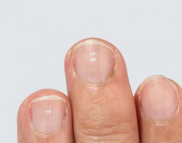 بررسی علل لکههای سفید روی ناخن کودکان بررسی علل لکههای سفید روی ناخن کودکان