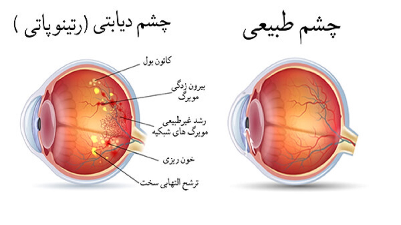 دیابت بیشترین تغییرات را در شبکیه چشم ایجاد میکند دیابت بیشترین تغییرات را در شبکیه چشم ایجاد میکند