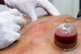 حجامت جای اهدای خون را نگیرد حجامت جای اهدای خون را نگیرد