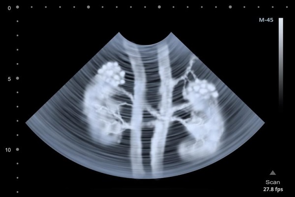 علائم سرطان کلیه را بشناسیم