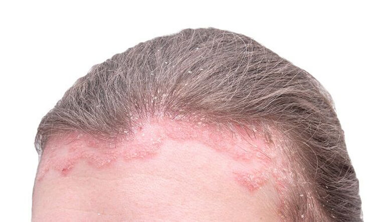 در تابستان از پوست خود مقابل این بیماری ها مراقبت کن