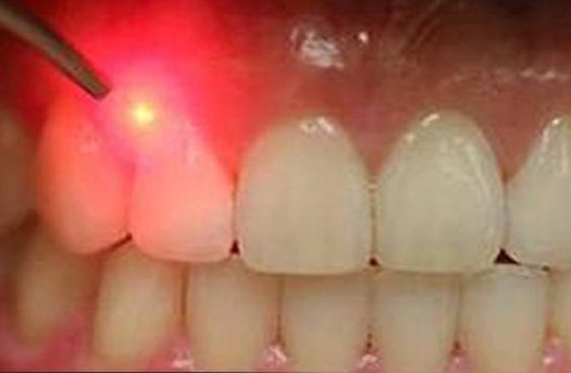 ثبت روش ایرانی درمان پوسیدگی دندان در کتب مرجع جهانی