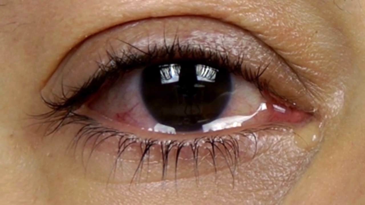 درمان خانگی برای رفع پف چشم