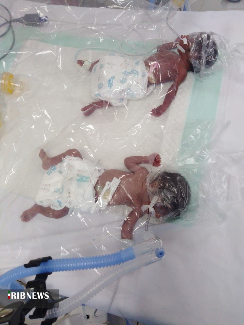 تولد دوقلو‌ها مادر را غافلگیر کرد