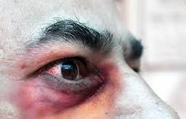 شناسایی بیمار مشکوک به قارچ سیاه در اردبیل شناسایی بیمار مشکوک به قارچ سیاه در اردبیل