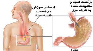 روش های درمان رفلاکس معده به مری