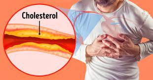 گرفتگی رگ‌های قلب و درمان آن