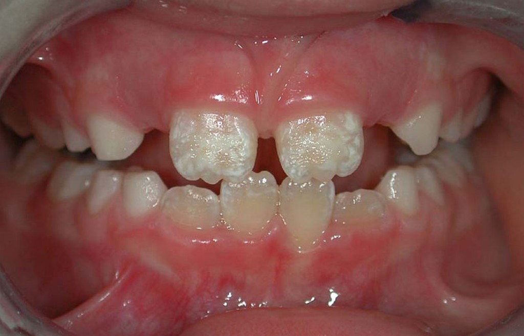 حاج آقایی// برخی داروها باعث نقص مینای دندان کودکان می‌شوند