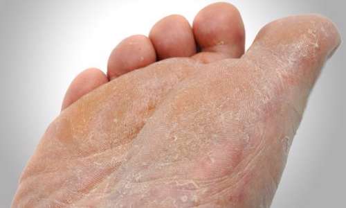 ۸ روش برای از بین بردن پوست مرده کف پا ۸ روش برای از بین بردن پوست مرده کف پا