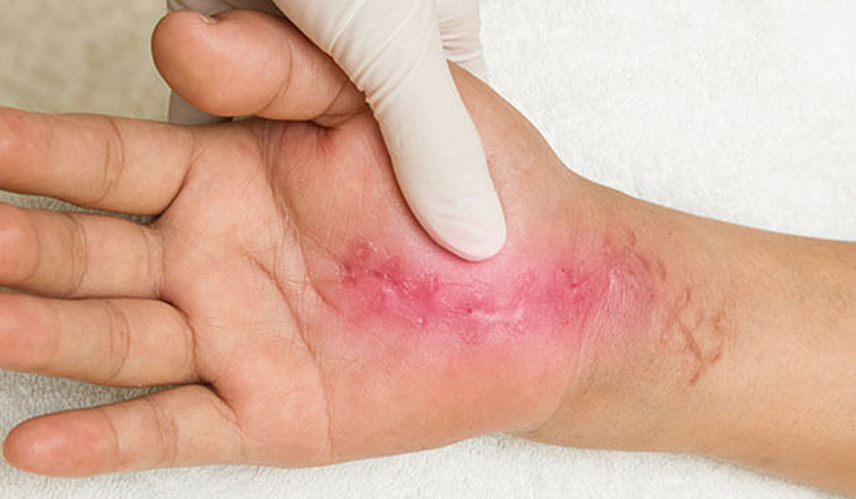 حاج آقایی// بهبودی جای زخم با تغییر ساعت شبانه روزی