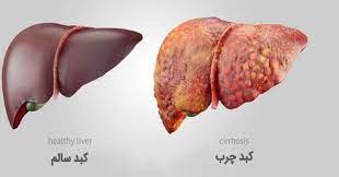 نشانه‌های کبد چرب در افراد