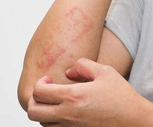 کنترل اگزمای بدن  با چند روش ساده