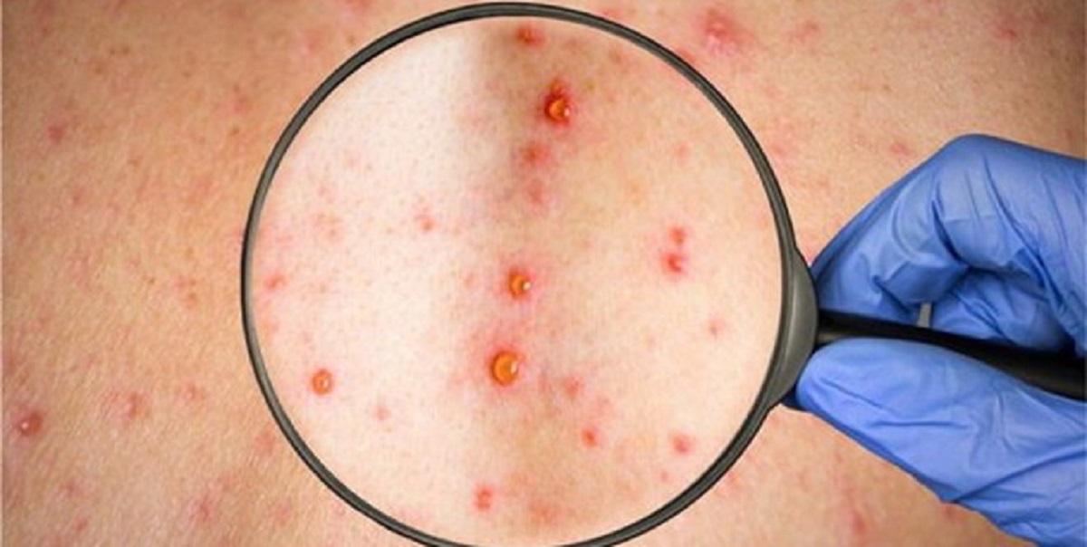 واکسیناسیون ، بهترین راه پیشگیری از سرخک