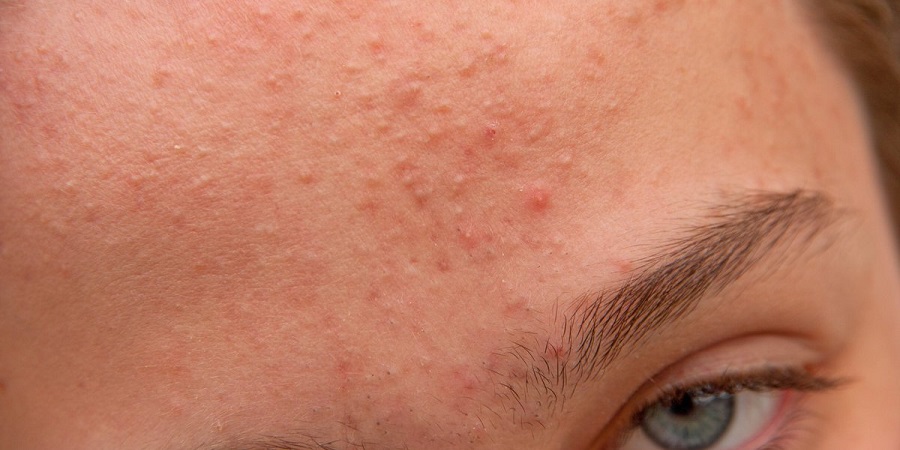 درمان جوش ها در بدن چیست؟ درمان جوش ها در بدن چیست؟