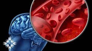 درمان آلزایمر با عوض کردن خون!