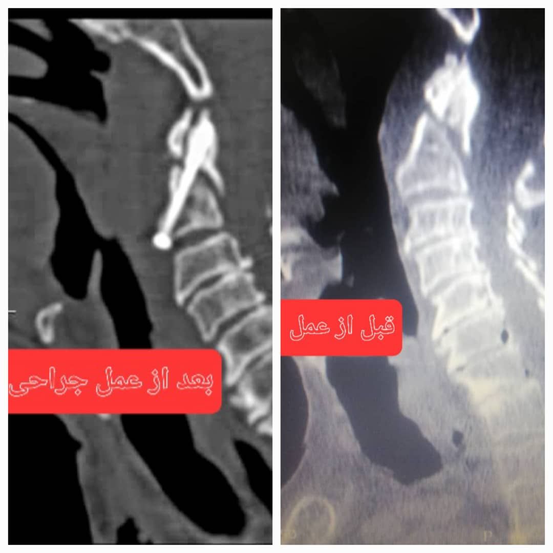 عمل موفقیت‌آمیز جراحی نخاعی در بیمارستان، ولی عصر (عج) بروجن