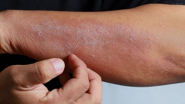 درمان عفونت‌های پوست و التیام زخم‌ها با روشی جدید