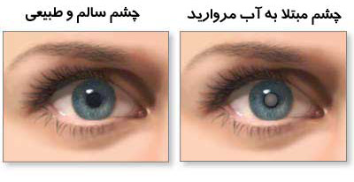 مرواریدهای دردسرآفرین در چشم
