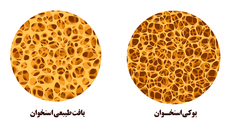 پوکی استخوان، اپیدمی خاموش عصر پوکی استخوان، اپیدمی خاموش عصر