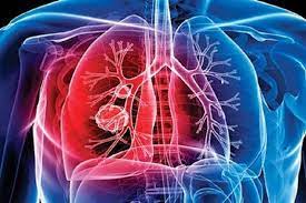 میزان بروز سل در یزد بالاتر از متوسط کشوری میزان بروز سل در یزد بالاتر از متوسط کشوری