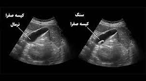 مهمترین علت تشکیل سنگ کیسه صفرا مهمترین علت تشکیل سنگ کیسه صفرا