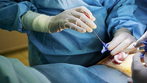 نخستین عمل پیوند آسپیراسیون مغز استخوان نخستین عمل پیوند آسپیراسیون مغز استخوان