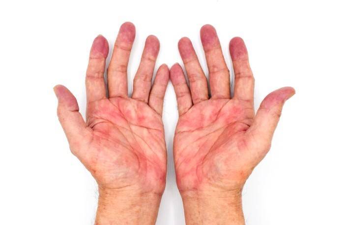ایجاد علامت بیماری های کبد روی دست ها