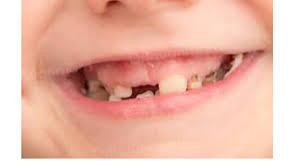 عوارض مصرف شیرینی و خوراکی جایگزین عوکودکی که تمام دندان هایش خراب است